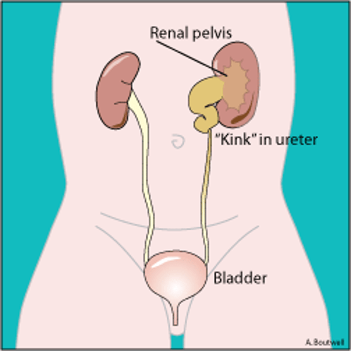 <p>abnormal condition of water in the kidney</p>