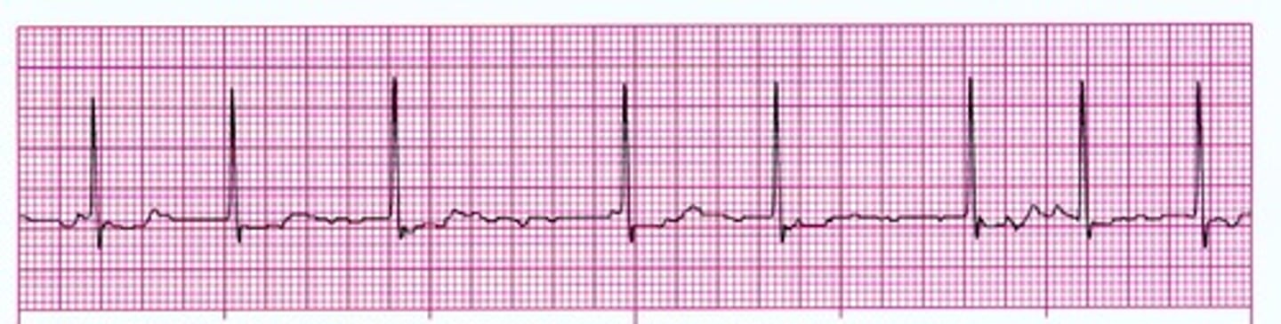 <p>P wave: wavy</p><p>PR interval: none</p><p>QRS 0.12</p><p>Atrial Rave &gt;400</p><p>Ventricular rate: irregular</p><p>atria deterioriate and quiver, not sending blood forward</p>