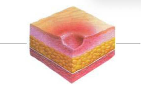 <p><strong>Partial-thickness tissue loss involving dermis and epidermis</strong></p><ul><li><p>Shallow open ulcer, blister, or abrasion with a red-pink and moist wound bed</p></li><li><p>No slough or bruising</p></li></ul><p></p>