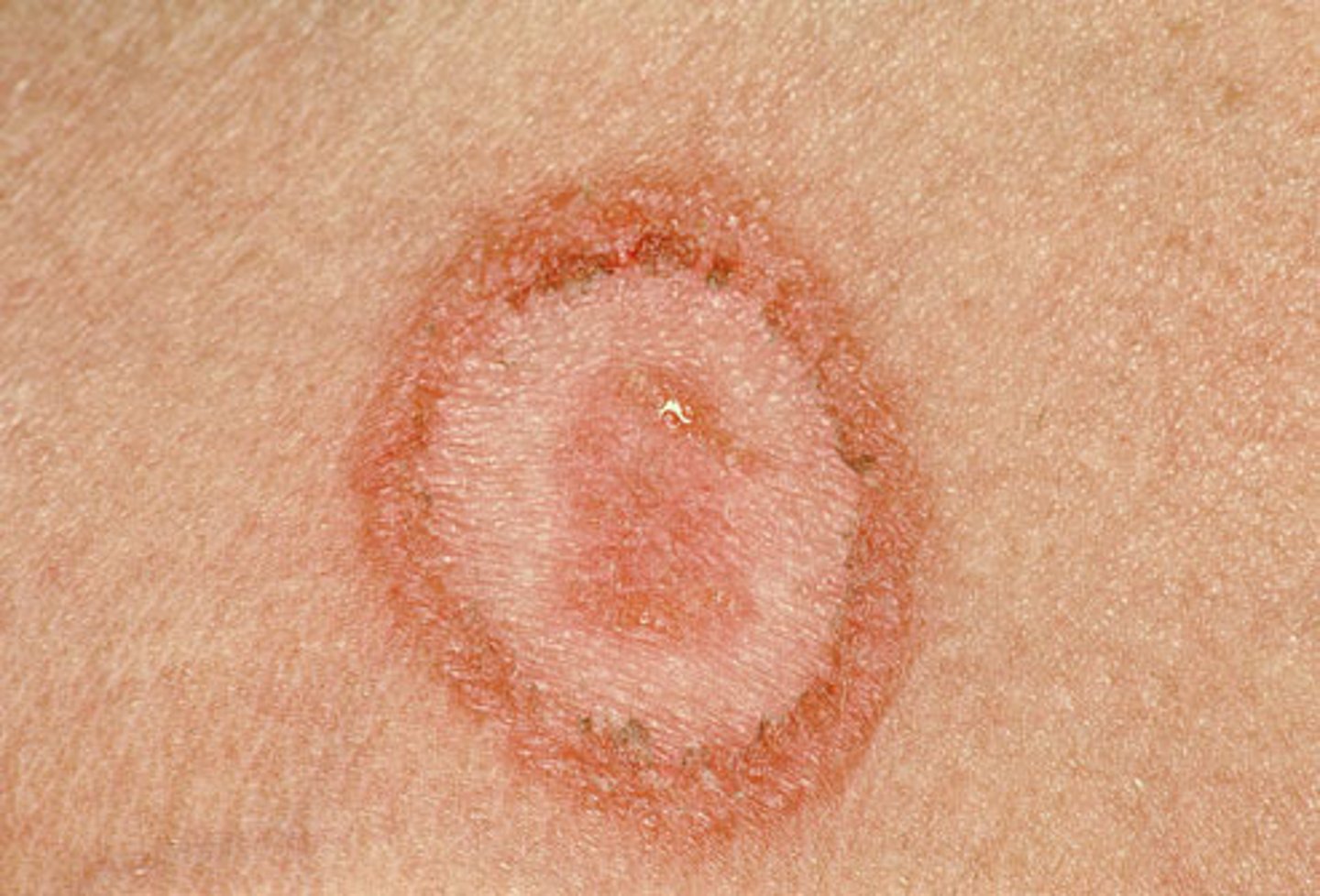<p>ringworm</p>
