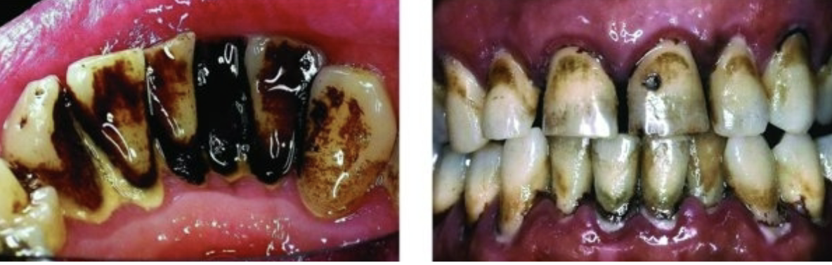 <p>• Halitosis</p><p>• Xerostomia</p><p>• Tobacco staining</p><p>• Periodontal disease</p><p>• Oral cancer</p>