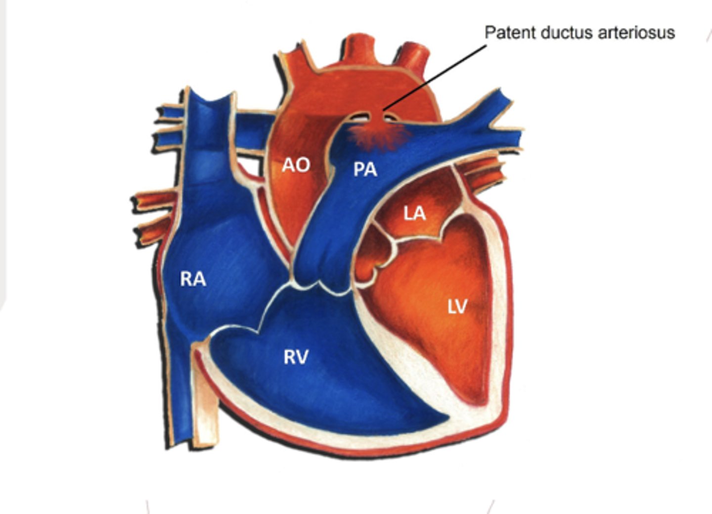 <p>- a congenital, non cyanotic heart defect in which the ductus arteriosus fails to close completely</p><p>- oxygenated blood is redirected from the descending aorta to the pulmonary artery</p>