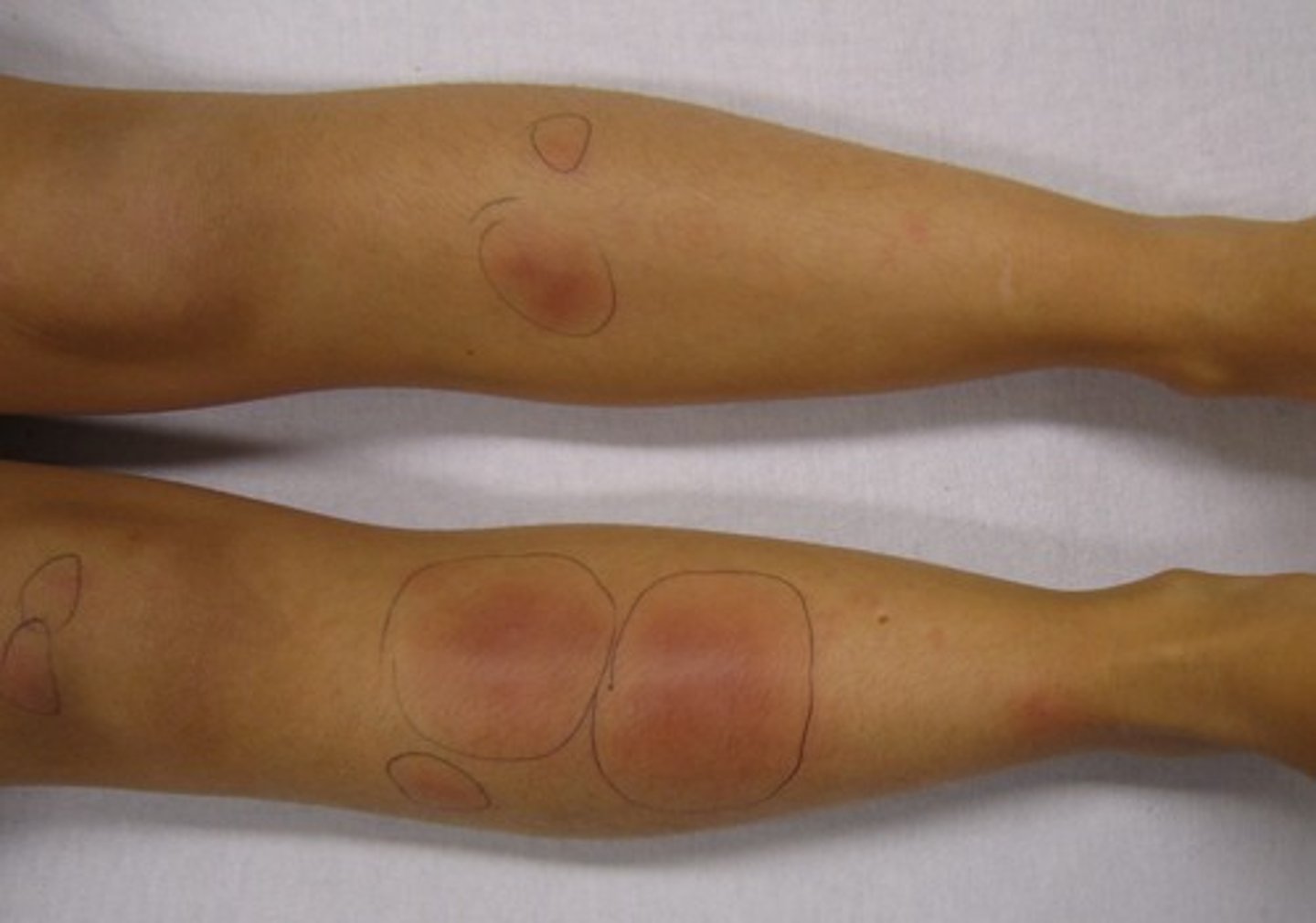 <p>B/L anterior lower legs (shins), Asymmetric</p>