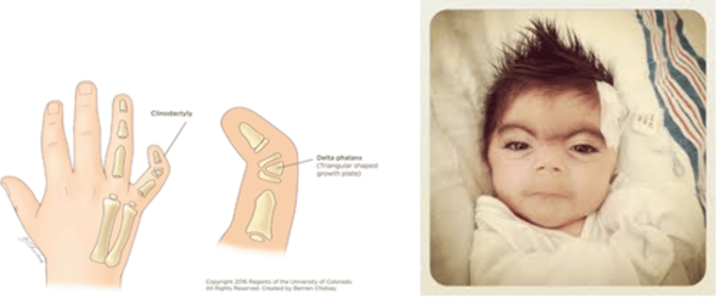 <p>genetic mutation characterized by:</p><p>- limb abnormalities</p><p>- microcephaly</p><p>- severe growth retardation</p><p>- spasticity</p><p>- intention tremor</p><p>- seizures</p><p>- clinodactyly of the fifth fingers</p><p>- respiratory and GI problems, congenital heart disease</p>
