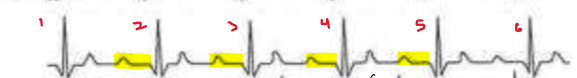 <p>What rhythm is present on the patient’s ECG trace?</p>