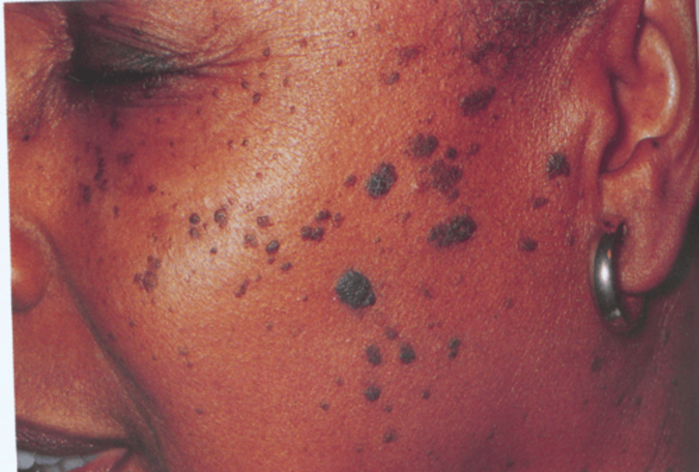 <p>Seborrheic Keratosis</p><p>- Brown, raised, "stuck on" lesions</p><p>- "Velvety"</p>