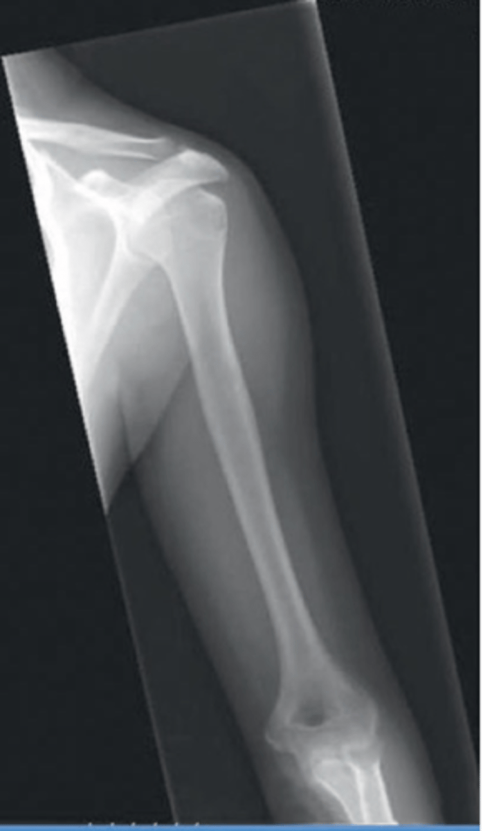 <p>- elboe anf shoulder</p><p>- epicondyles</p><p>- humeral head and greater tubercle</p><p>- lesser tubercle</p>