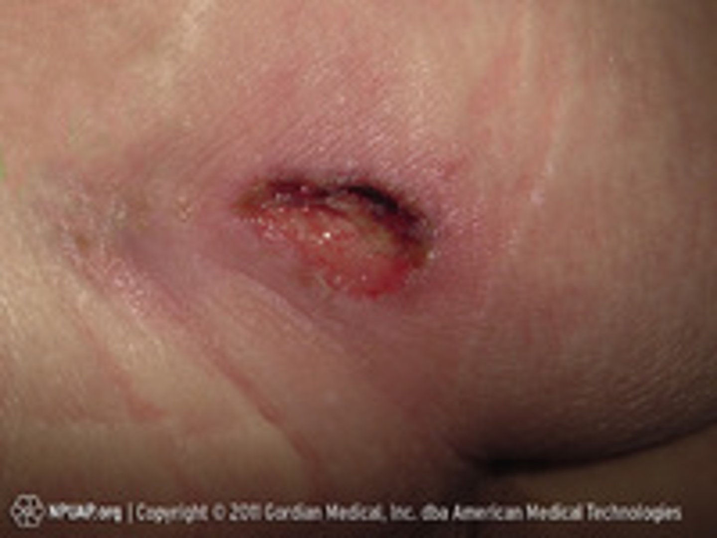 <p>- Full-thickness tissue loss</p><p>- Subq fat may be visible, granulation tissue and rolled wound edges, slough and eschar</p><p>- Undermining and tunneling may occur</p>