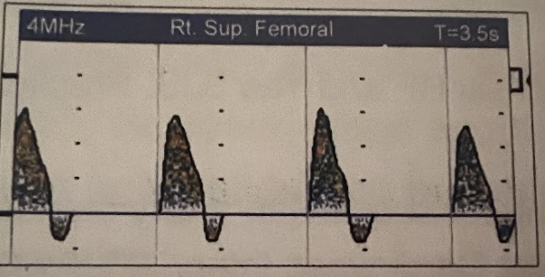 <p>Based on the new waveform nomenclature system, what is appropriate name for this femoral waveform? </p>