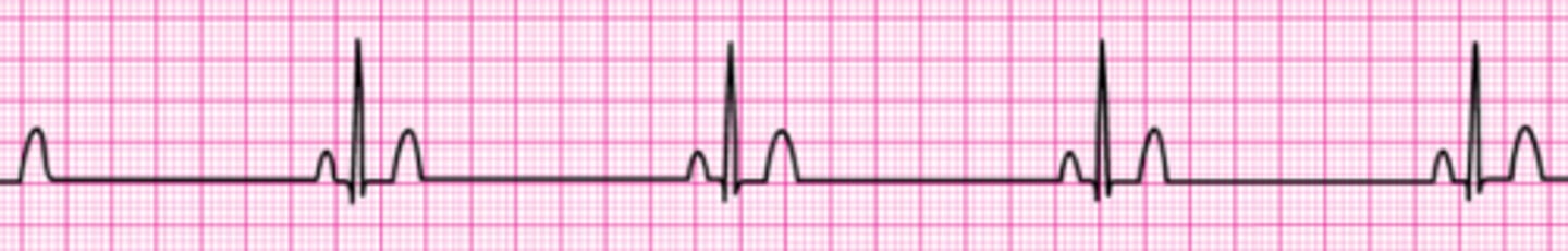 <p>The patient suddenly becomes unconscious and has a weak carotid pulse. Cardiac monitoring, supplementary oxygen, and an IV have been initiated. The code cart with all the drugs and transcutaneous pacer are immediately available. Next you would:</p><p>1. Begin transcutaneous pacing.</p><p>2. Initiate dopamine at 10 to 20 mcg/kg per minute and to patient response.</p><p>3. Initiate dopamine at 2 to 10 mcg/kg per minute and titrate to patient response.</p><p>4. Give atropine 0.5 mg IV .</p><p>5. Initiate epinephrine at 2 to 10 mcg/kg per minute.</p>