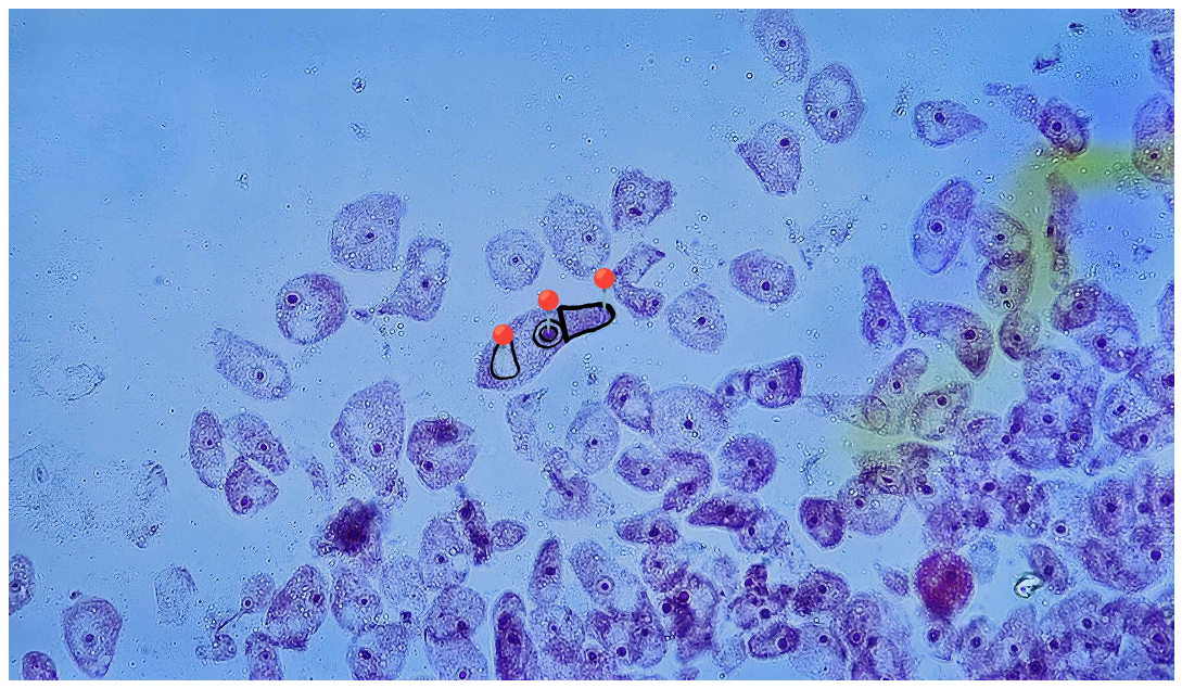 <p><strong><em>Acanthamoeba castellani</em></strong></p><p>(Trofozoit)</p><p></p><p><strong>Organelle:</strong></p><p></p><ul><li><p><span data-name="red_circle" data-type="emoji">🔴</span>- pseudopodium (akantopodium);</p></li></ul><p></p><ul><li><p><span data-name="red_circle" data-type="emoji">🔴</span><span> - </span>jądro komórkowe + kariosom;</p></li></ul><p></p><ul><li><p><span data-name="red_circle" data-type="emoji">🔴</span><span> - </span>wodniczka tętniąca.</p></li></ul><p></p><p></p><p><strong>Parazytoza:</strong> <em>Akantomeboza</em></p><p></p>