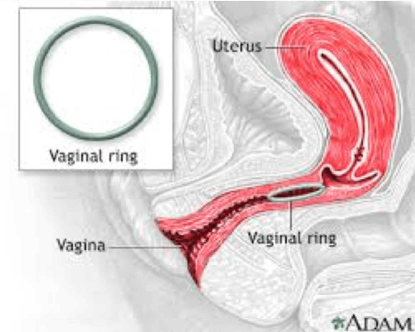 <p>ring that releases hormones</p><p>-Hormonal</p>