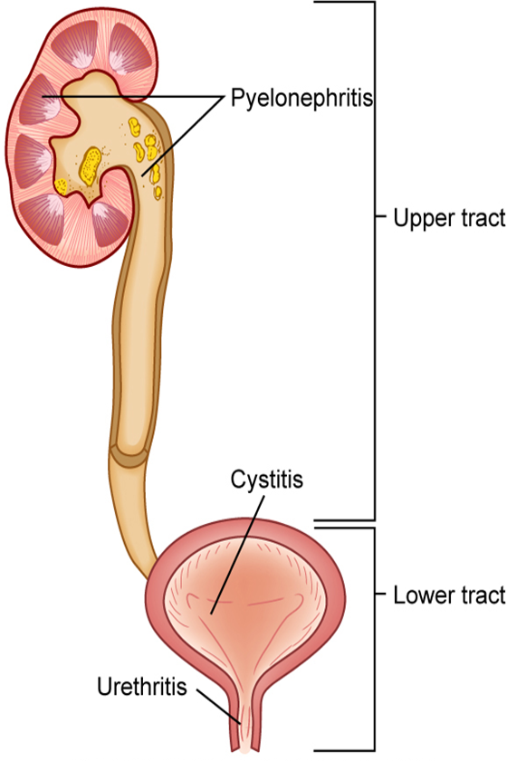 <p><span>•Upper versus Lower</span></p><p></p><p><span>•Urosepsis&nbsp;</span></p><p></p><p><span>•Uncomplicated versus Complicated</span></p><p></p><p><span>•CAUTI</span></p>