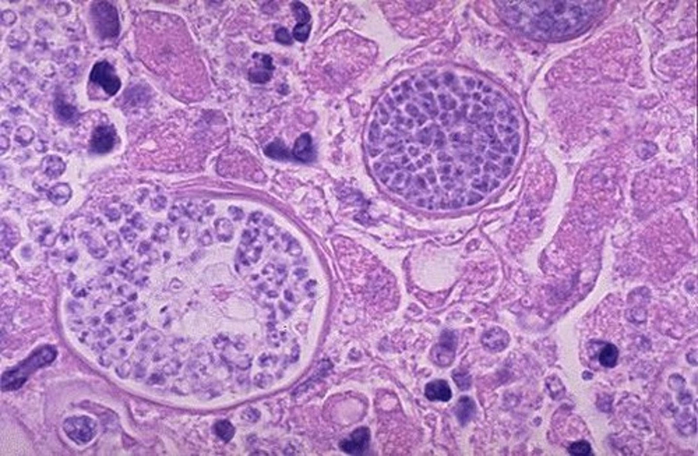 <p>Sleeping sickness.</p>