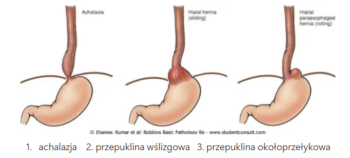 <p><span style="color: green"><strong><mark data-color="green" style="background-color: green; color: inherit">PRZYCZYNY:</mark></strong></span></p><ul><li><p>wzrost ciśnienia w jamie brzusznej (dźwiganie ciężarów, przewlekły kaszel, wymioty, nadmierne napinanie mięśni w trakcie oddawania stolca)</p></li><li><p>palenie papierosów</p></li><li><p>spożywanie jednoczasowo obfitych posiłków</p></li></ul><p><span style="color: green"><strong>PRZEPUKLINA WŚLIZGOWA</strong></span></p><ul><li><p>stanowi ok. <strong>95% </strong>przypadków przepuklin przełykowych, występuje u 1-20% dorosłych</p></li><li><p>na skutek osłabienia siły mięśniowej do klatki piersiowej przedostaje się górna część żołądka oraz jego wpust, brzuszna część przełyku (w tym dolny zwieracz) </p></li><li><p>objawy:</p><ul><li><p>zarzucanie treści pokarmowej do przełyku (refluks) → stany zapalne śluzówki żołądka → ból w śródpiersiu (często mylony z bólem towarzyszącym zawałowi)</p></li></ul></li><li><p>powikłania:</p><ul><li><p>owrzodzenie</p></li><li><p>perforacja</p></li><li><p>krwawienie</p></li><li><p>zadzierzgnięcie</p></li></ul></li></ul><p><span style="color: green"><strong>PRZEPUKLINA OKOŁOPRZEŁYKOWA</strong></span></p><ul><li><p>rzadsze, ale mogą być groźniejsze??</p></li><li><p>żołądek przemieszcza się do klatki obok przełyku → dolny zwieracz przełyku pozostaje na swoim miejscu</p></li><li><p>do klatki piersiowej może przemieścić się prawie cały żołądek</p></li><li><p>objawy:</p><ul><li><p>duszność</p></li><li><p>czasami zaburzenia rytmu serca (przyspieszenie akcji serca)</p></li></ul></li></ul><p></p>