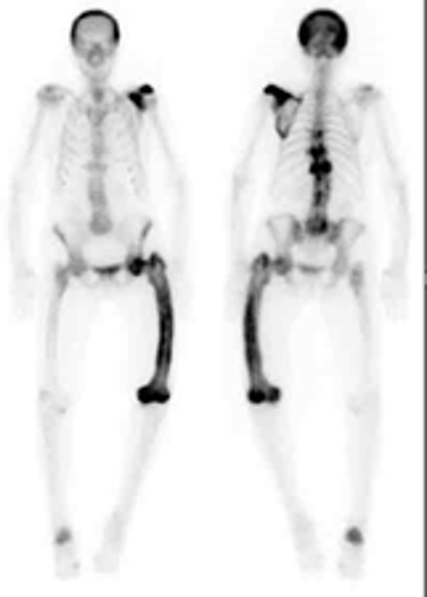 <p>Paget's disease</p>