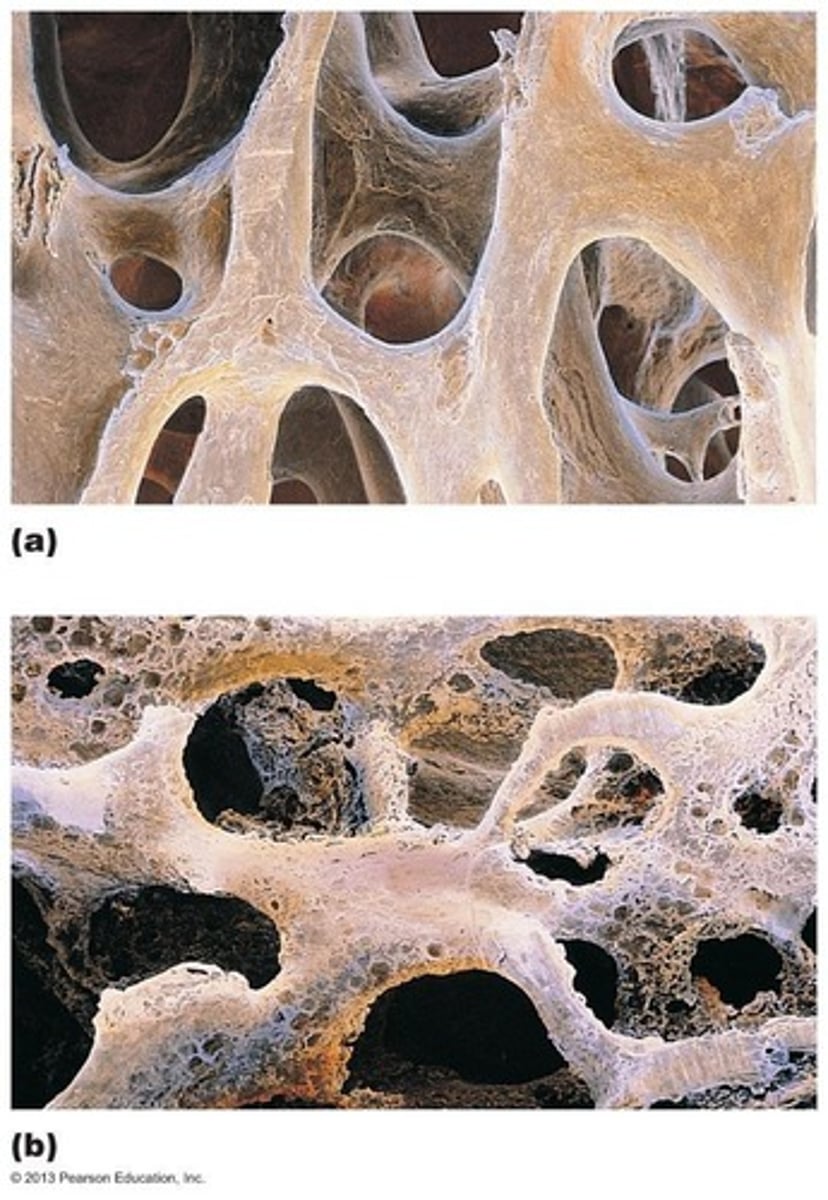<p>Condition where bone resorption outpaces deposit, leading to fragile bones.</p>