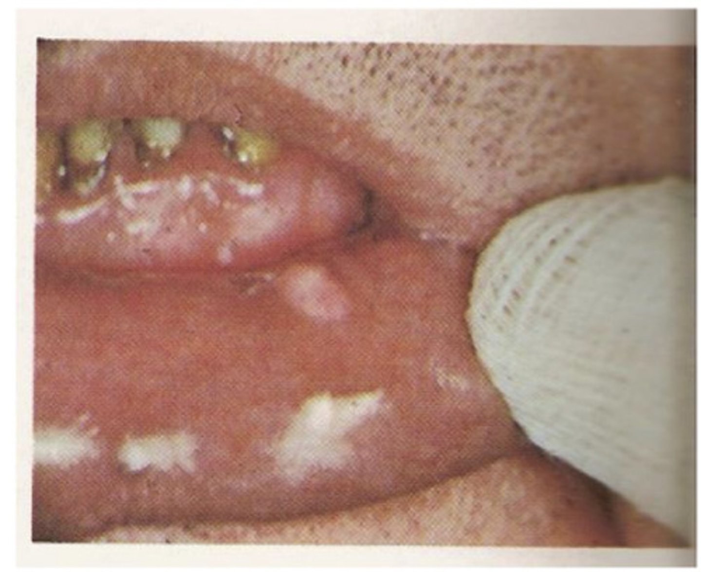 <p>tumor made up of nerve cells (benign) - can be due to trauma</p>