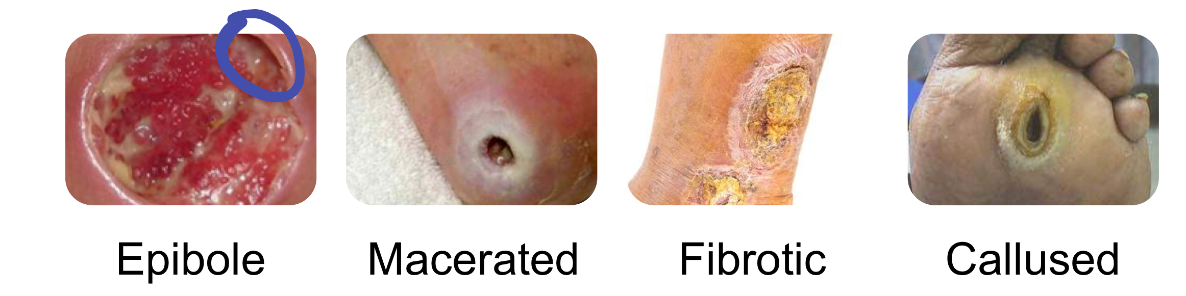 <ul><li><p>Epibole</p></li><li><p>Macerated </p></li><li><p>Fibrotic </p></li><li><p>Callused </p></li></ul><p></p>