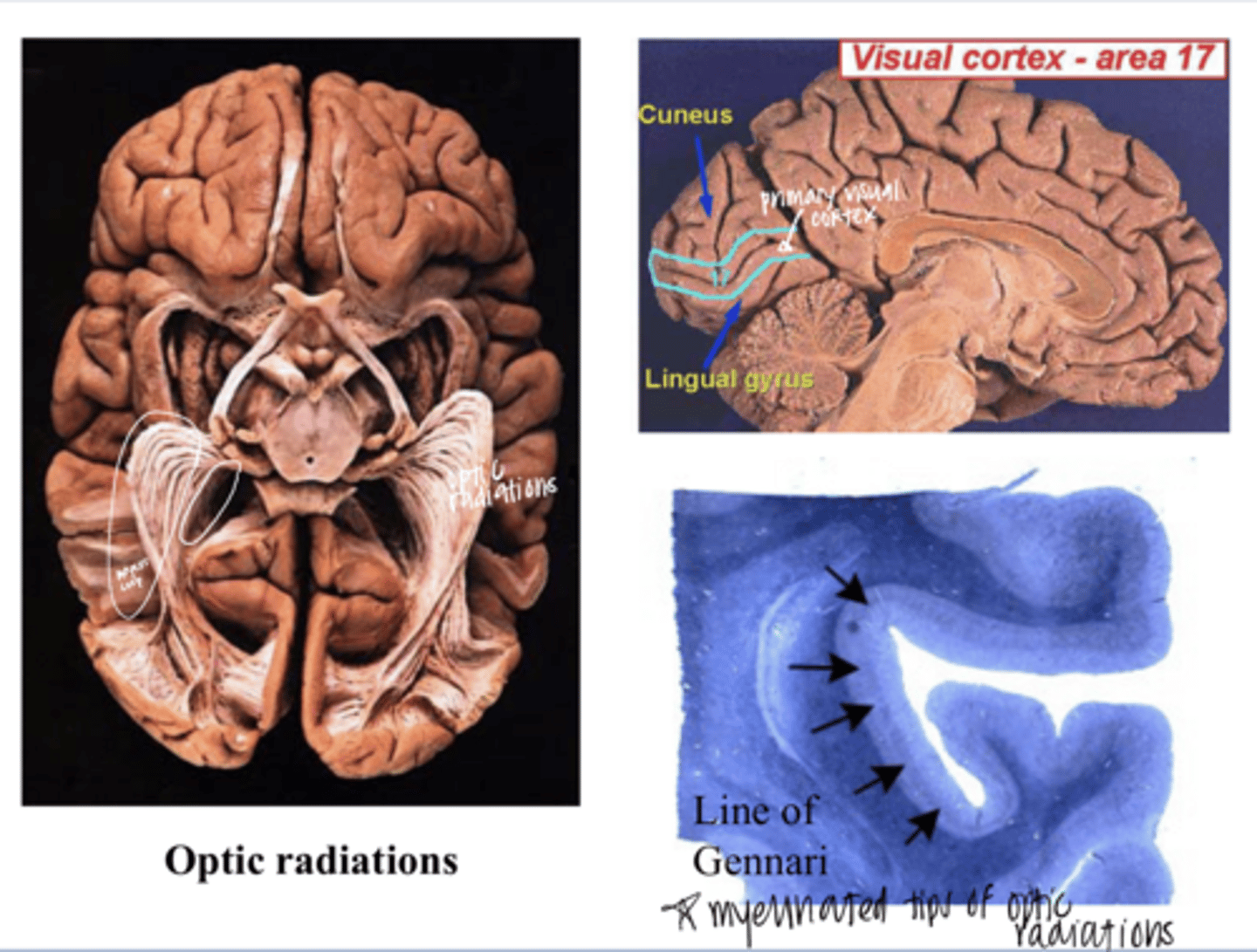 <p>Image of the Superior and Inferior Optic Radiations</p>