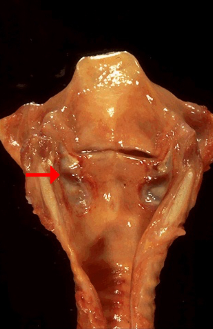 <ol><li><p>Ulcer (caused by mechanical forces)</p></li><li><p>"pressure ulcers" or "decubitus ulcers"</p></li></ol><p></p><p>According to webpath, this is an ulcer. But, Robbins Atlas says that this is a case of laryngeal erosion. An ulcer is an area of full-thickness loss of the mucosa (an erosion is a partial-thickness loss).</p><p></p>