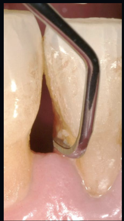 <p>what is the instrumentation of the crown and root surfaces of the teeth to remove plaque, calculus and stains with scalers and curettes?</p>