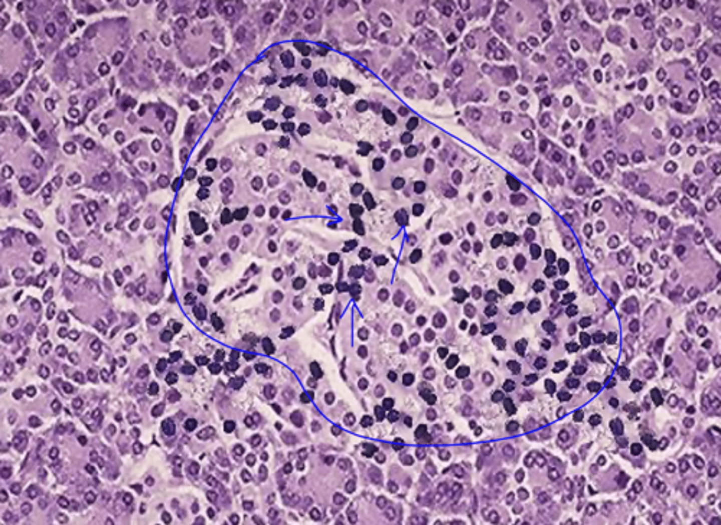 <p>leukocyte infiltrates in the islets (insulitis)</p><p>islet atrophy</p>