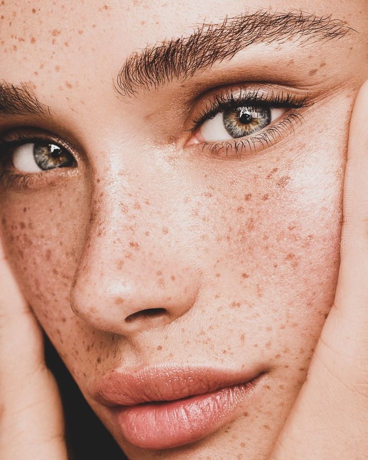 <p><span>freckled face</span></p><p><span>freckles</span></p>