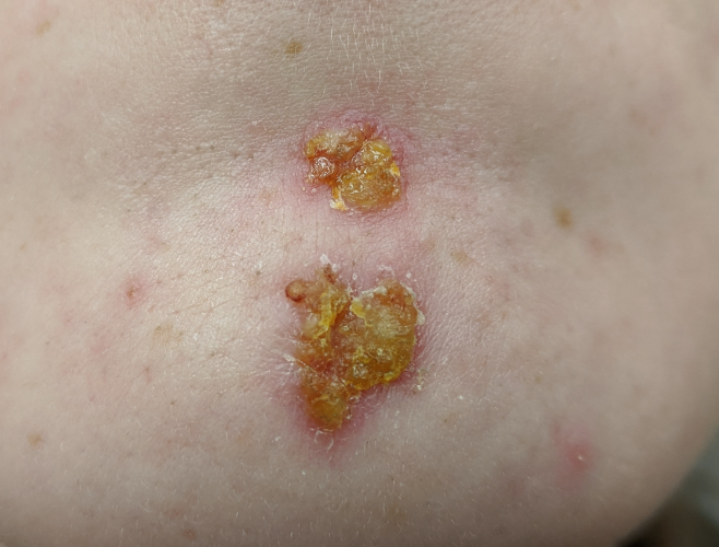 Impetigo