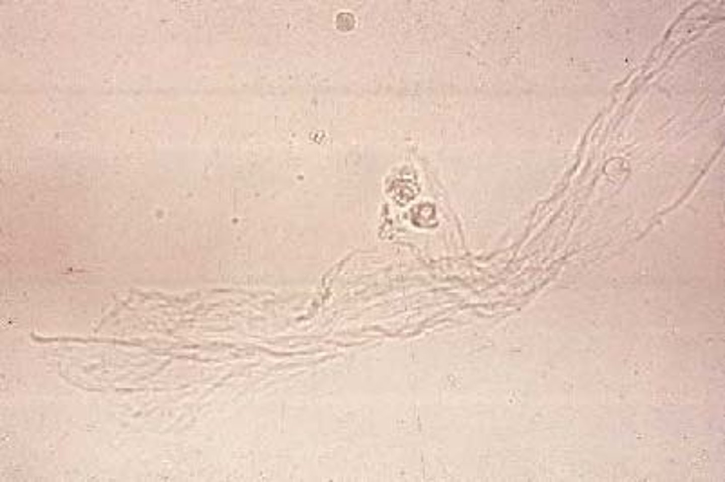 <p>Is a protein material produced by the glands and epithelial cells of the lower genitourinary tract and RTE cells. It is made up of Uromodulin (Tamm-Horsefall protein).</p><p>- It has an irregular and string-like appearance in the sample</p><p>- It has no clinical significance ever in either males or females</p><p>- It is just an irritant to have in the sample</p>