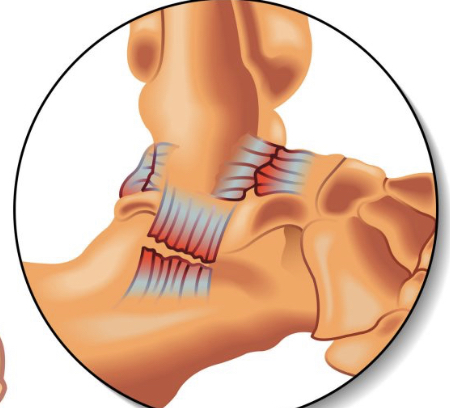 injury to a ligament, grade 1: microtear, grade 2: tear goes thru ligament, some laxity, endpoint
