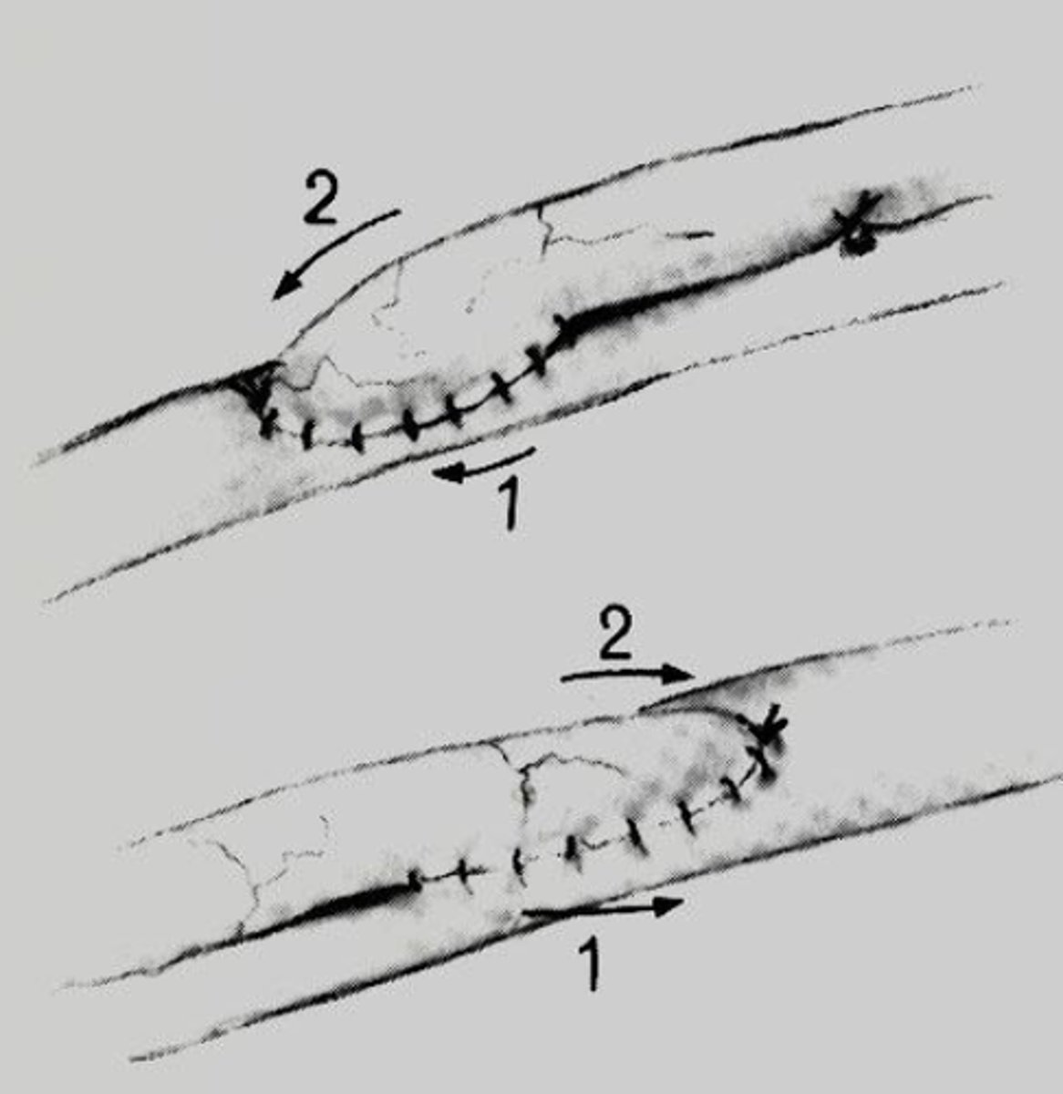 <p>n. a connection made surgically between adjacent blood vessels, parts of the intestine, or other channels of the body, or the operation in which this is constructed.</p>