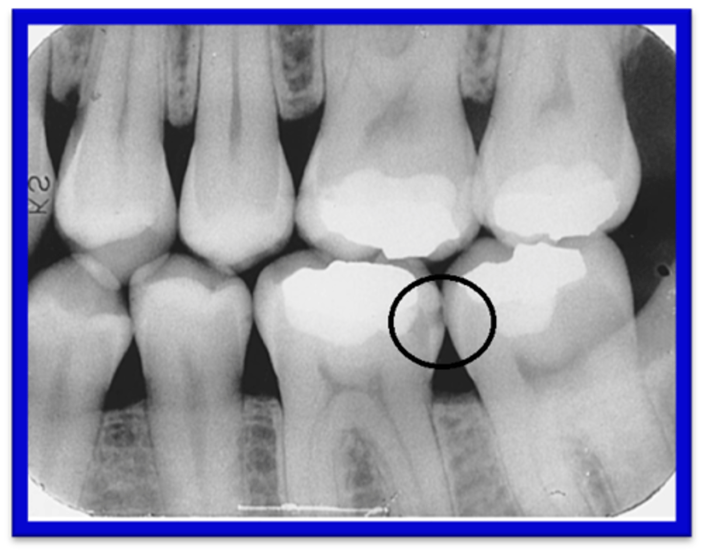 <p>To examine the crowns of maxillary and mandibular teeth, adjacent tooth surfaces, and crestal bone</p>