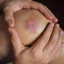 <p>What is the superficial discoloration caused by a hemorrhage into the tissue from ruptured blood vessels beneath the skin surface (aka contusion)?</p>