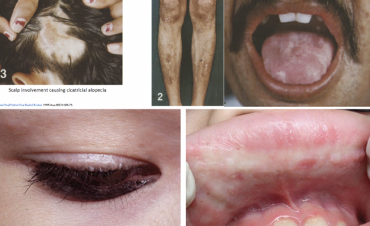 <p>-rare autosomal recessive; mutation of ECM1 gene which encodes glycoprotein ECM protein 1</p><p>-deposition of waxy material in the dermis and submucosal connctive tissue</p>