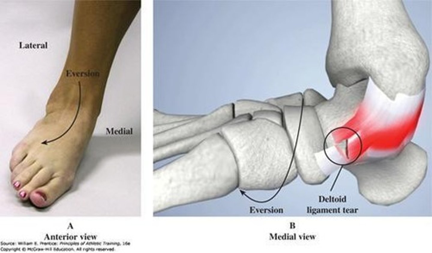 <p>Deltoid ligament injury.</p>