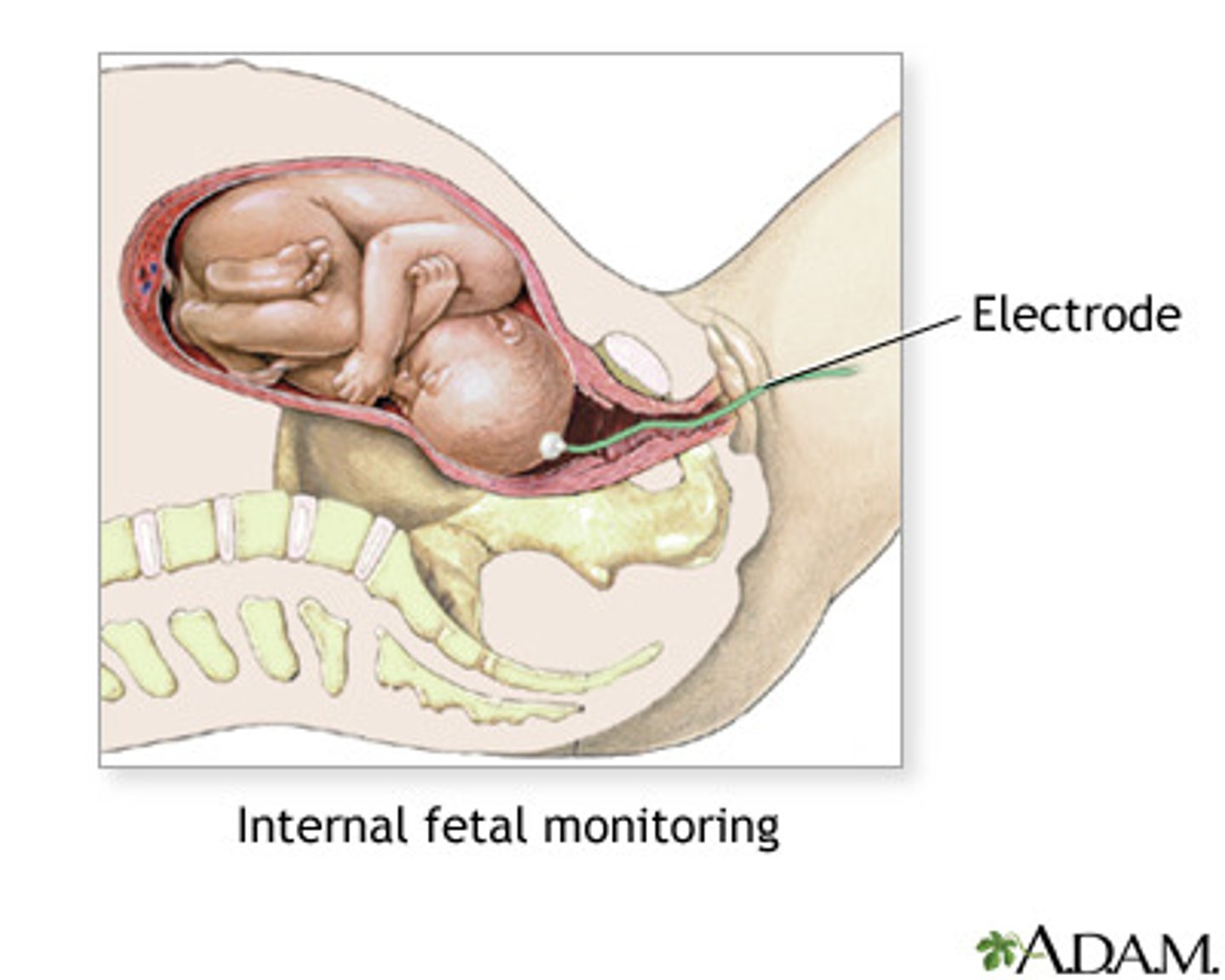 <p>a fetus with late decels bc the FSE is more sensitive by tracking the potential difference created by depolarization of the fetal heart; it also is better because the tracings do not get lost during contractions or fetal position changes like they do with the Doppler</p>