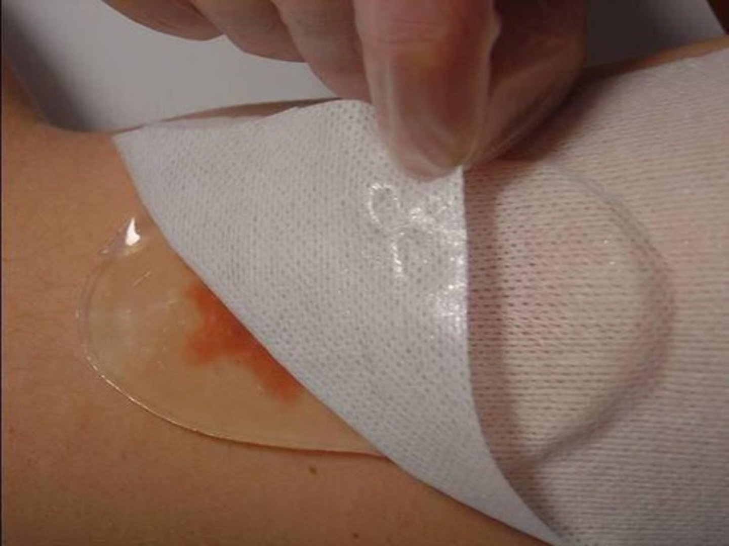 <p>water or glycerine based gels, used with partial or full thickness wounds with necrosis (tissue damage from burns or radiation), absorbs minimal exudate but lets some pass through secondary dressing</p><p>When: arterial insufficiency wounds</p><p>Advantages: conforms to wound, rehydrates/moistens wound bed, promotes autolytic debridement, soothing and cooling, transparent, non-adherent, amorphous form can be used when infection present</p><p>Disadvantages: not used with high exudate, most require secondary dressing, may macerate surrounding skin</p>