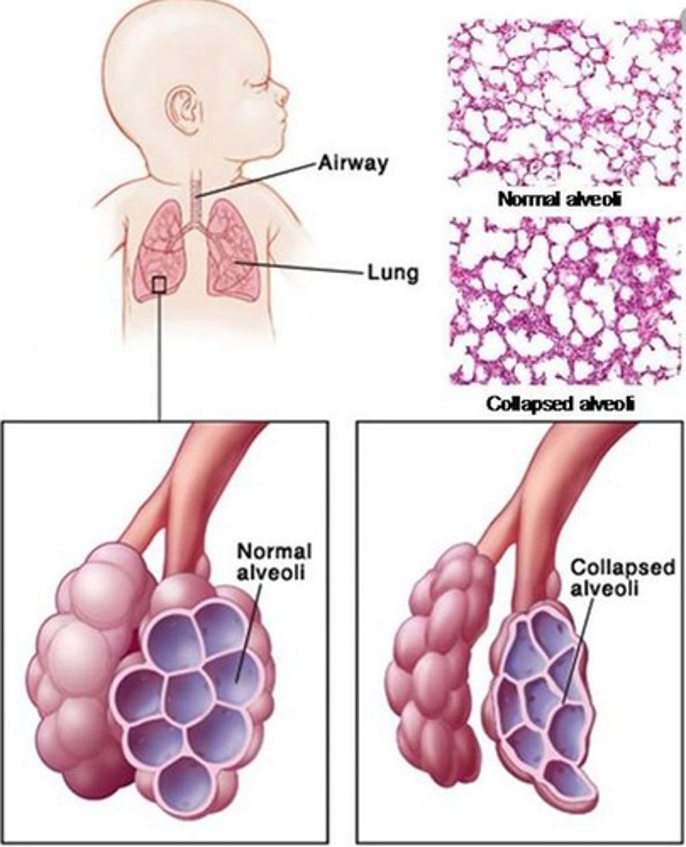 <p>A condition caused by a lack of pulmonary surfactant, leading to breathing difficulties in infants.</p>