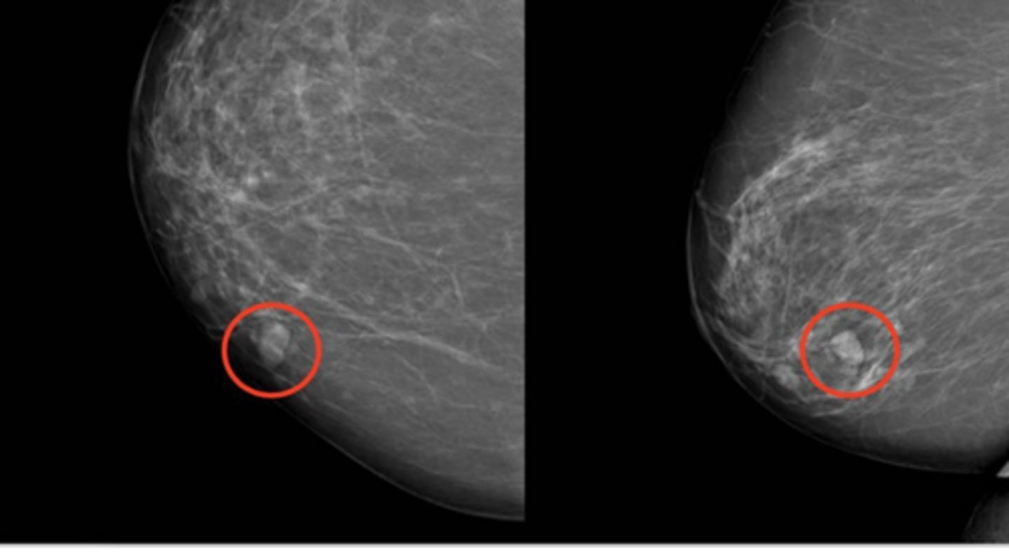 <p>Define Breast Cancer:</p><p>Breast cancer at its earliest stage before the cancer has broken through the wall of the milk duct</p><p>-Hx:</p><p>-Path: NONInvasive</p><p>&gt; Fills ductal lumen (arises from DUCTAL ATYPIA)</p><p>&gt; Early malignancy WITHOUT basement membrane penetration</p><p>-Sx/PE: Not usually palpable</p><p>-Dx: Mamm = Micro-calcifications</p><p>-Prog: Inc risk of cancer in same breast/quadrant</p>