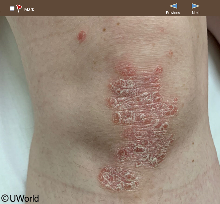 <p>35M hx several months of skin lesions, small papules → increased size, no pain or pruritis. plumber (kneels frequently). </p>