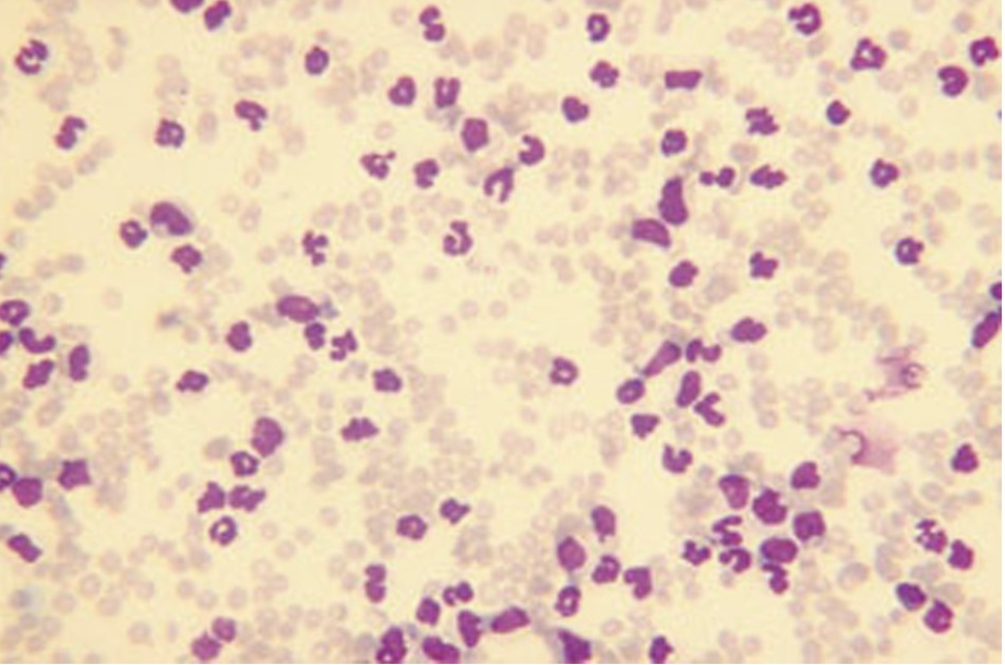 The blood film below could be described as characteristic of a
