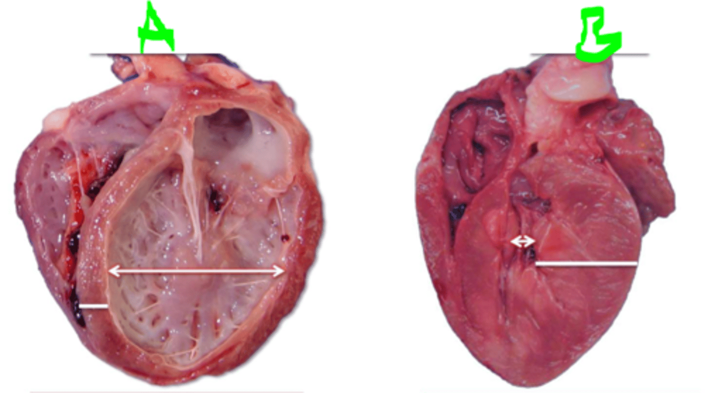 <p>Which heart represents an eccentric hypertrophy of the heart? Which represents concentric hypertrophy of the heart?</p>