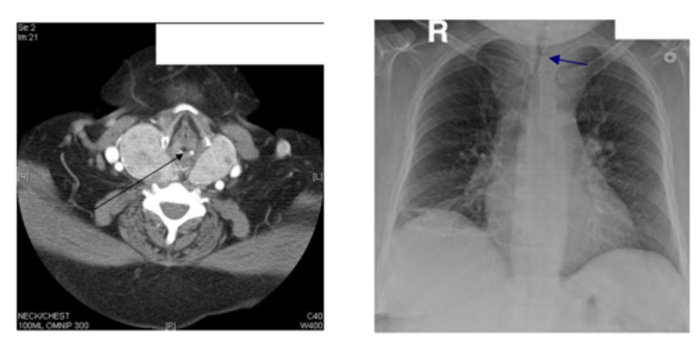 <p>patient presents with the following CT and X-Ray. What is the diagnosis?</p>