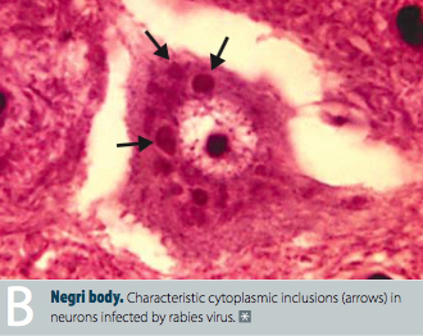 <p>💉 Family: Rhabdoviridae (Lyssavirus)</p><p>Disease: Rabies</p><p>Systems: Nervous system</p><p>⚠️ Clinical Signs: Furious form—aggression, hypersalivation; Dumb form—paralysis, lethargy; always fatal</p><p>🔬 Histopathology: Negri bodies in hippocampus &amp; Purkinje cells, nonsuppurative encephalitis</p><p>☣️ Highly zoonotic and fatal</p>
