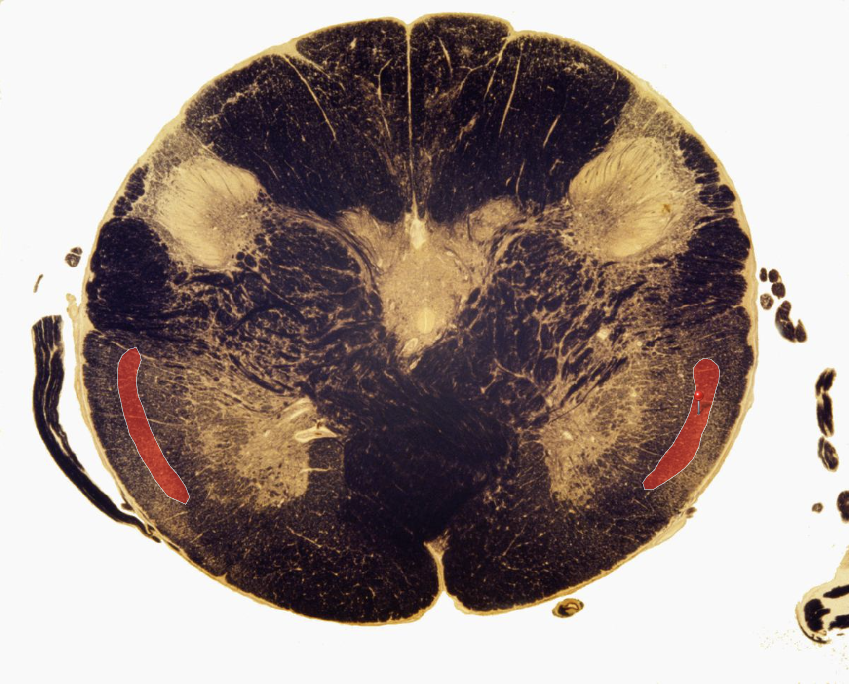 <p>Spinomedullary Junction &amp; Spinothalamic Tract</p>