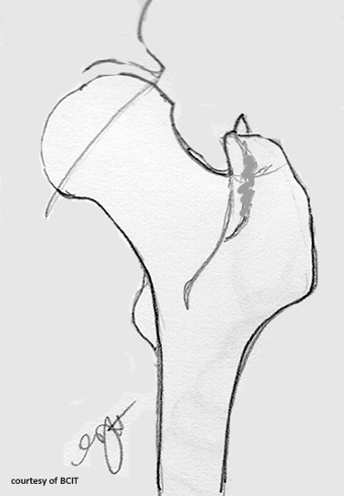 <p>Mechanism producing a pelvic avulsion fracture?</p>