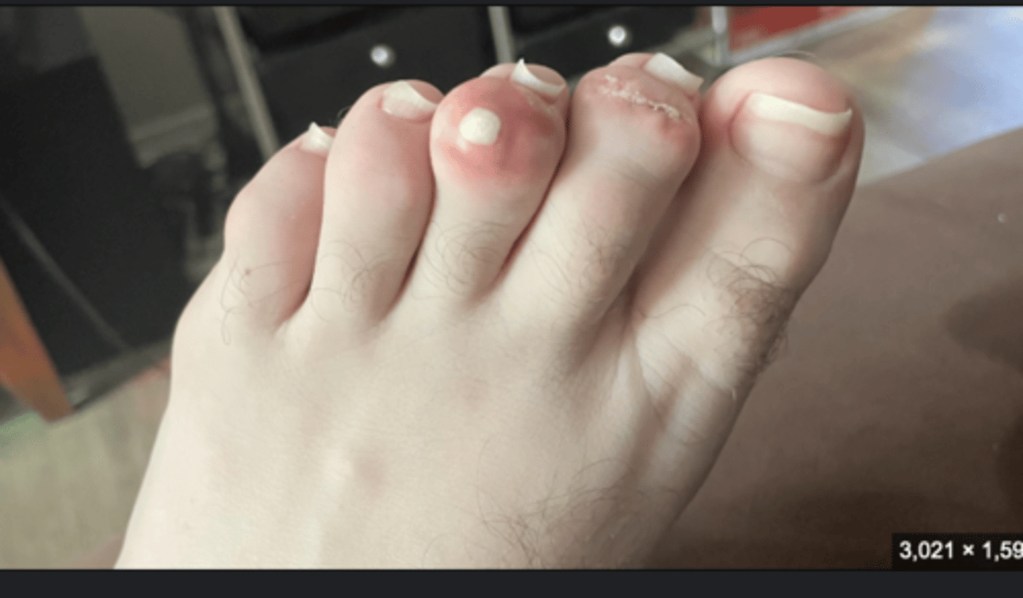 <p>- Gout is a type of arthritis caused by the accumulation of monosodium urate crystals in and around the joints</p><p>- most commonly first presents in MTP - metatarsophalangeal joints</p><p>- chronic untreated gout can lead to the formation of tophi (hard nodules)</p><p>commonly in :</p><p>ankle, wrist, knee, 1st MTP</p><p>(gout = </p>