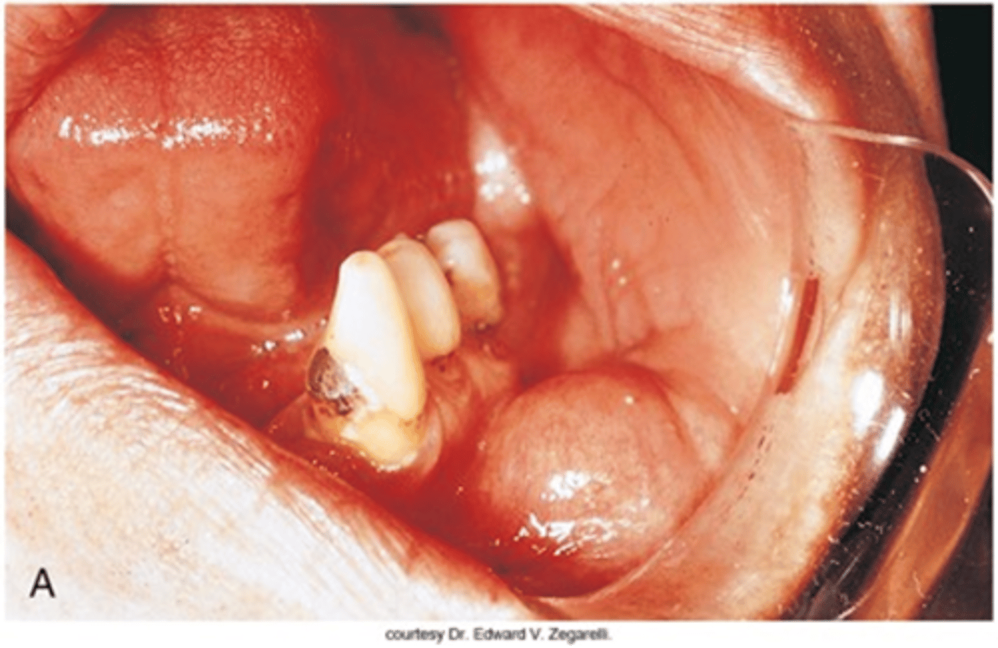 <p>a benign, slow-growing fatty tumor located between the skin and the muscle layer</p>