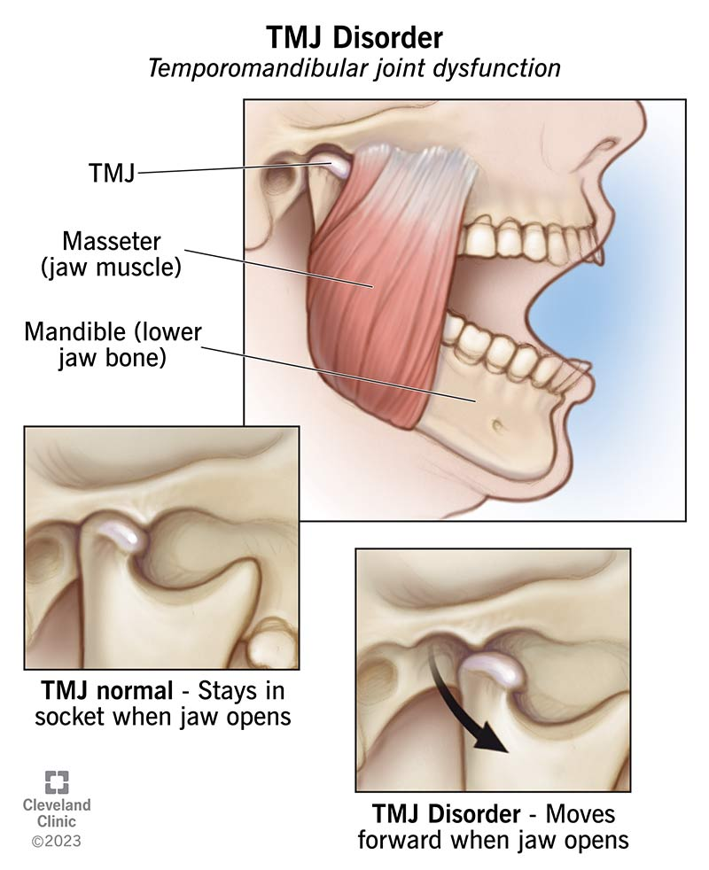 <p>TIME PS H RNR or FIBRO (Fatigue, Insomnia, Blues, Rigidity, Ow)</p><p></p><p>-Temporomandibular joint stx’s</p><p>-IBS</p><p>-Morning stiffness</p><p>-Exercise intolerance (musc. decond.)</p><p></p><p>-Psyc (anxiety, depression)</p><p>-Sicca stx’s (Sjogren’s; dry mouth and dry eyes)</p><p></p><p>-H/a</p><p>-RLS</p><p>-Non-cardiac chest pain</p><p>-Raynaud’s</p>